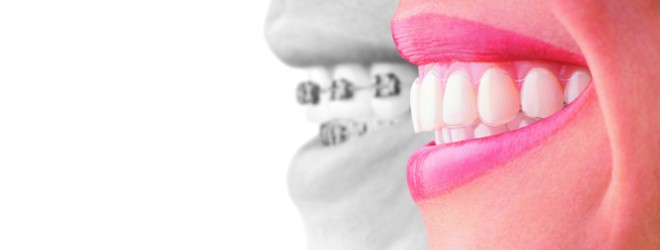 Invisalign compare to braces